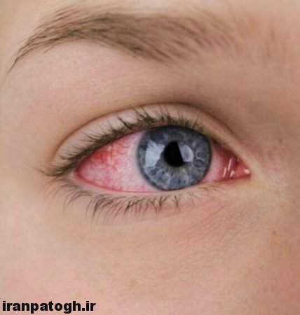 علت قرمزی چشم ,احساس وجود شن در چشم و درمان آن,بررسی دلایل قرمزی چشم , احساس وجود شن در چشم نشانه خشکی چشم,قرمزی چشم و خشکی چشم,درمان قرمزی چشم,علت خشکی چشم