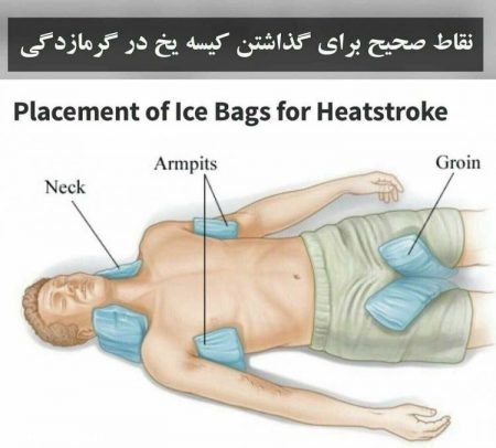 استفاده از کیسه یخ در گرمازدگی, کیسه یخ در گرمازدگی بهترین درمان ,نقاظ مناسب برای گذاشتن کیسه یخ ,رفع گرمازدگی ,نقاط صحیح برای گذاشتن کیسه یخ در گرمازدگی