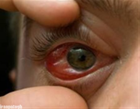 خونریزی چشم چیست